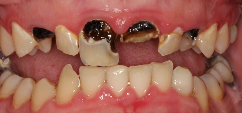 Răng bị sâu nên bọc sứ hay trám răng?