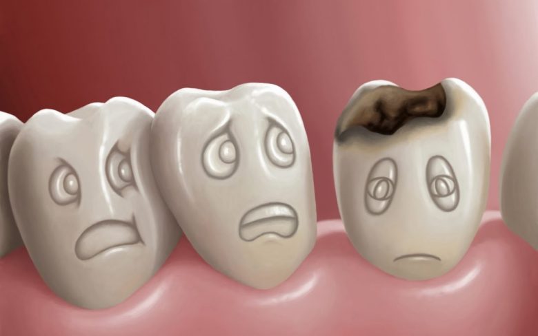 Răng bị sâu nên bọc sứ hay trám răng?