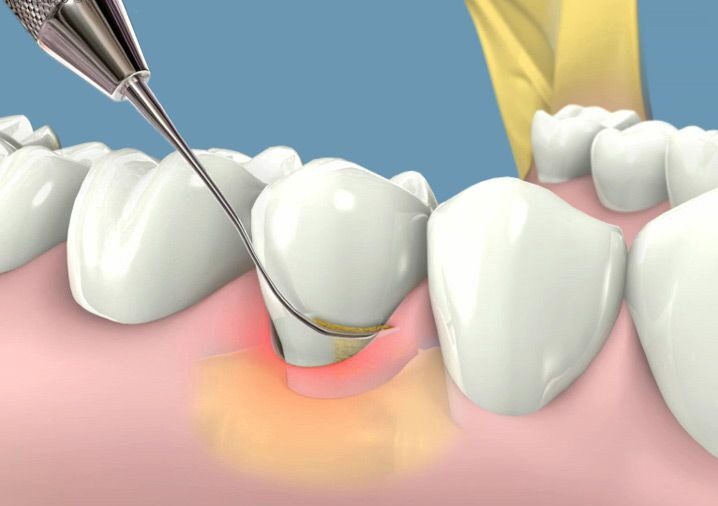 Vì sao nên lấy cao răng định kỳ?