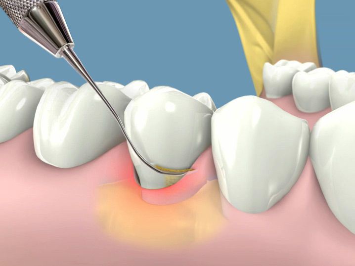 Vì sao nên lấy cao răng định kỳ?