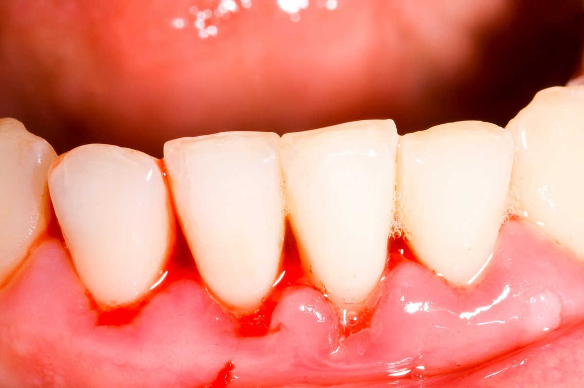 Gây nên những viêm nhiễm và đầu tiên là gây ra sâu răng, viêm nướu.