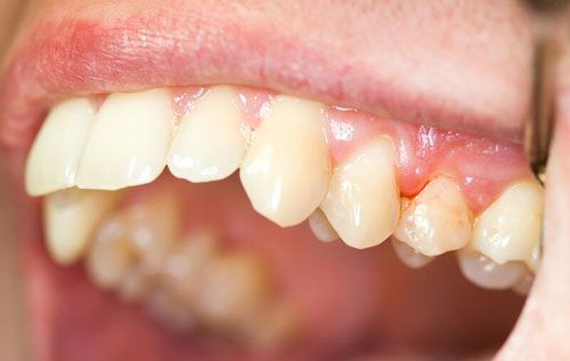 Trường hợp nào chống chỉ định với phương pháp tẩy trắng răng?