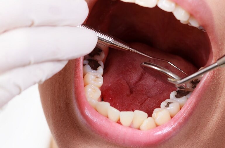 Nhổ răng sâu có bị biến chứng gì không?