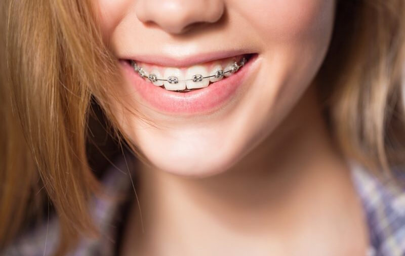 Hướng dẫn cách ăn uống cho người mới niềng răng
