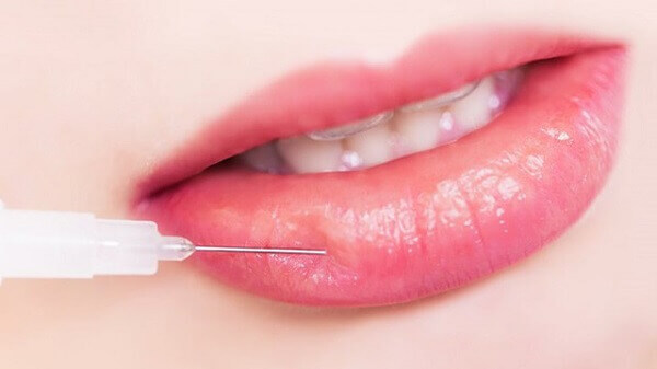 Tiêm Filler môi và những điều cần lưu ý tại Bệnh viện thẩm mỹ MEDIKA