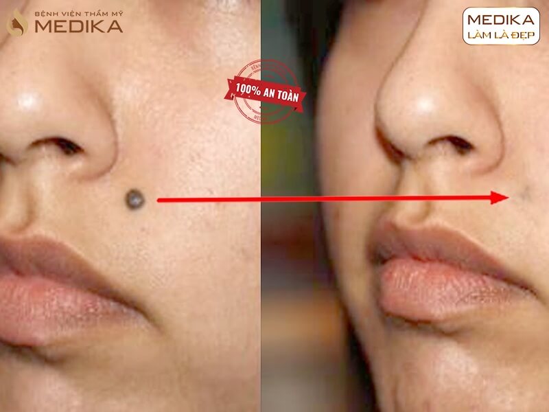 Cách chăm sóc da sau khi xóa nốt ruồi bằng Laser để tránh để lại sẹo MEDIKA.vn