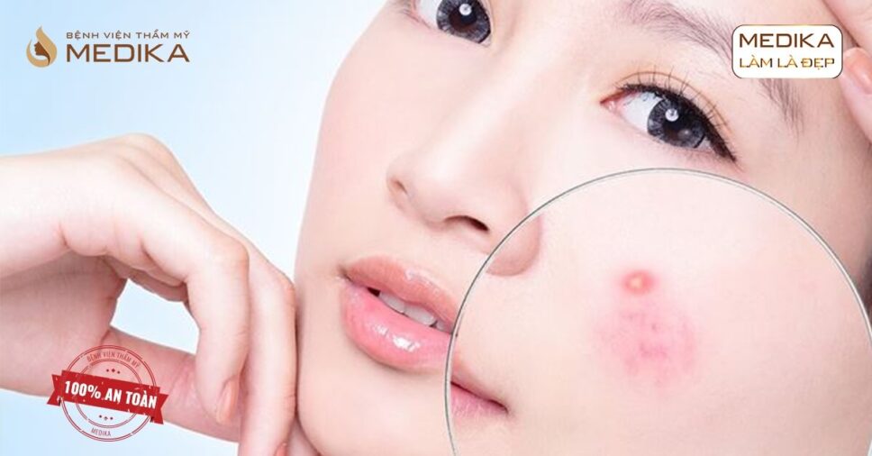 Có cần thiết thực hiện điều trị mụn bằng Laser?