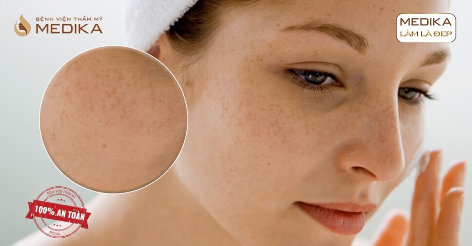 Điều trị tàn nhang bằng laser tại BVTM MEDIKA có gì khác?