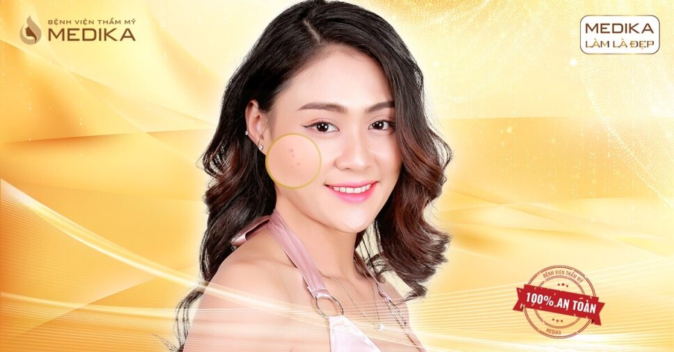 Điều trị mụn tại bệnh viện thẩm mỹ MEDIKA có gì khác?