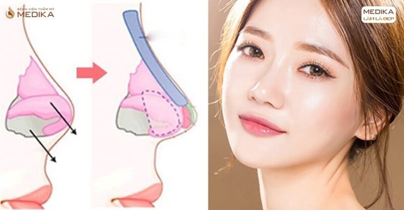 Lý do khiến nâng mũi bọc sụn tạo cơn sốt trong thị trường thẩm mỹ - MEDIKA.vn