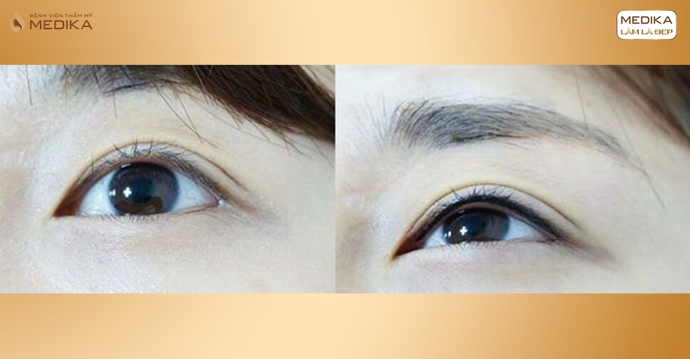 Hình ảnh trước sau phun mí Eyeliner - MEDIKA.vn