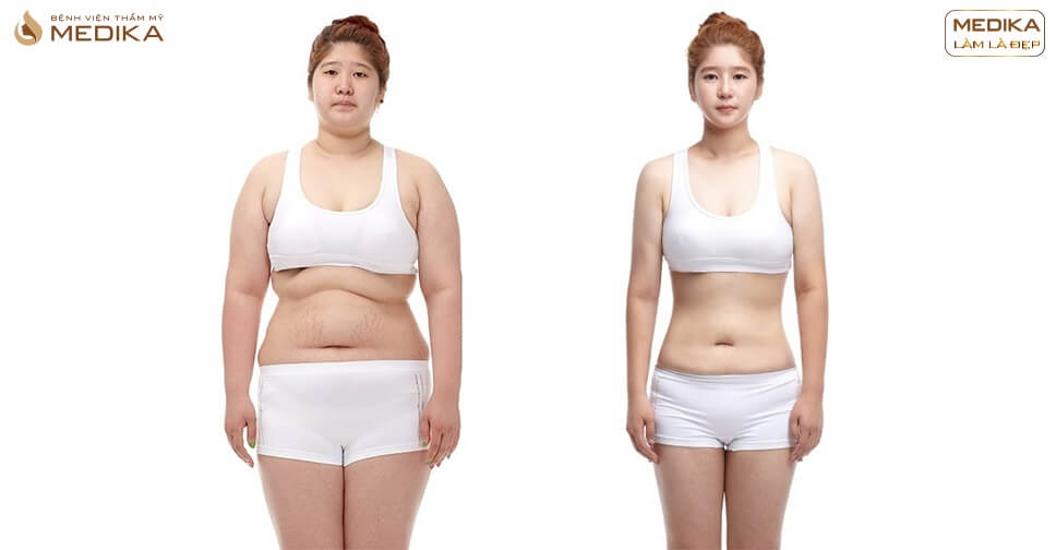 Hút mỡ an toàn hiệu quả ở đâu? - Bệnh viện thẩm mỹ MEDIKA