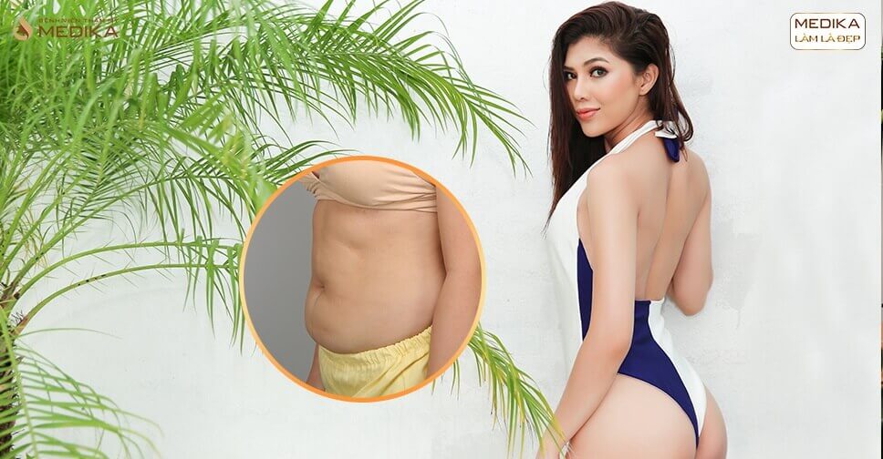 Chi phí hút mỡ hiện nay? Bảng giá hút mỡ nội soi tại Medika chi-phi-hut-mo-hien-nay-bang-gia-hut-mo-noi-soi-tai-medika