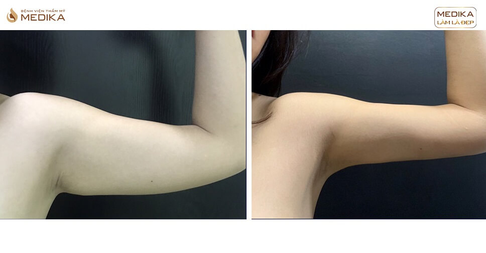 Giải pháp hút mỡ tay an toàn, hiệu quả trong tích tắc