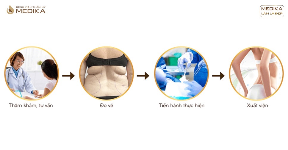 Hút mỡ lưng bao nhiêu tiền? Có hiệu quả không?