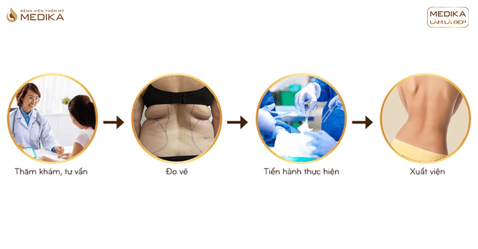 Hút mỡ lưng nguy hiểm không? Thời gian thực hiện bao lâu?