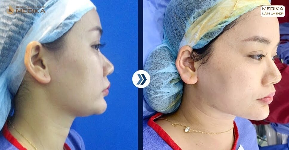 Hút mỡ nọng cằm bao nhiêu tiền? Có nguy hiểm không?