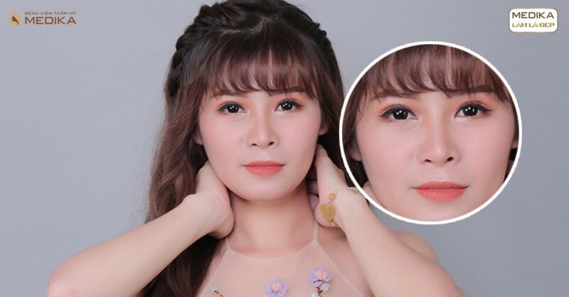 Mở rộng góc mắt trong để lại sẹo khi nào?