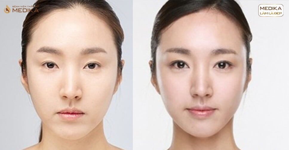 Phẫu thuật mắt to có đau không? Chi phí bao nhiêu?