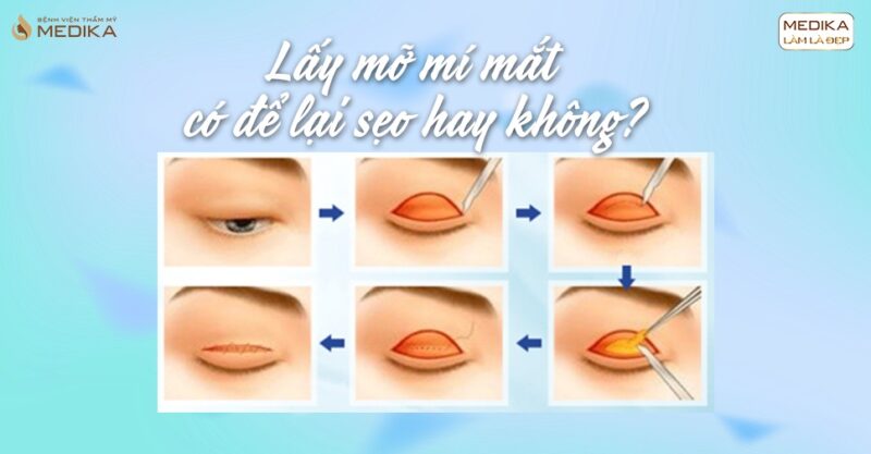 Lấy mỡ mí mắt có để lại sẹo hay không?