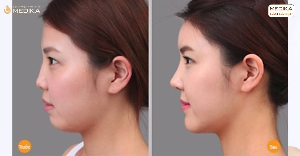 Hiện tại thì hút mỡ nọng cằm giá bao nhiêu vậy chị em? hien-tai-thi-hut-mo-nong-cam-gia-bao-nhieu-vay-chi-em