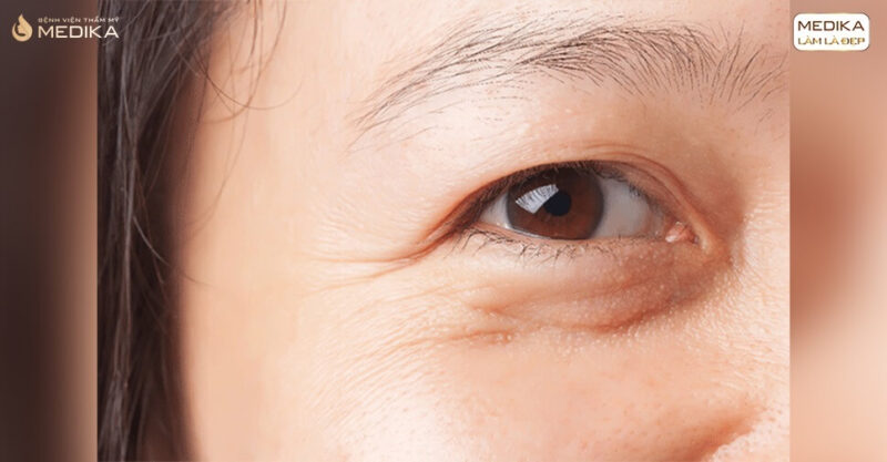 Dấu hiệu lão hóa ở mắt cho thấy sức khỏe đôi mắt yếu đi