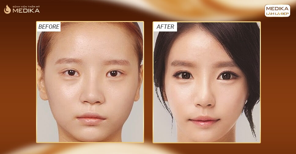 Các kĩ thuật áp dụng trong phẫu thuật mắt to