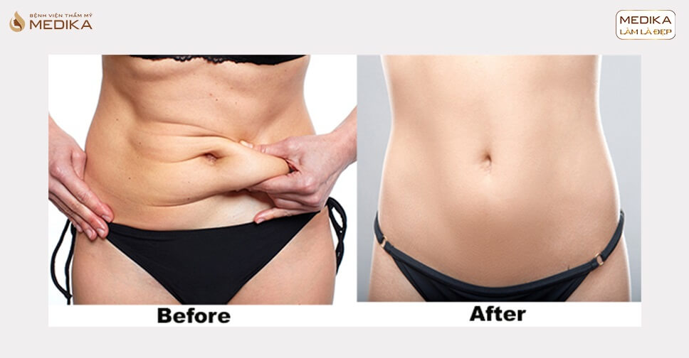 khac-phuc-loi-lom-sau-hut-mo-bung Khắc phục lồi lõm sau hút mỡ bụng