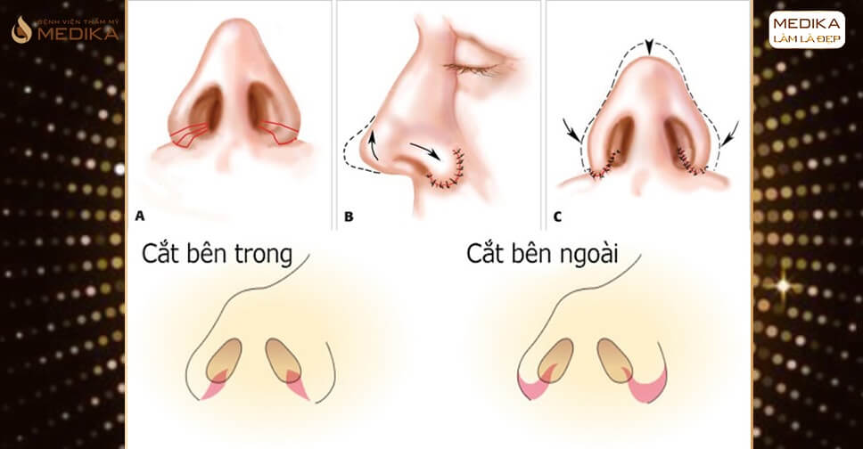 Những câu hỏi thường gặp về cắt cánh mũi - MEDIKA.vn
