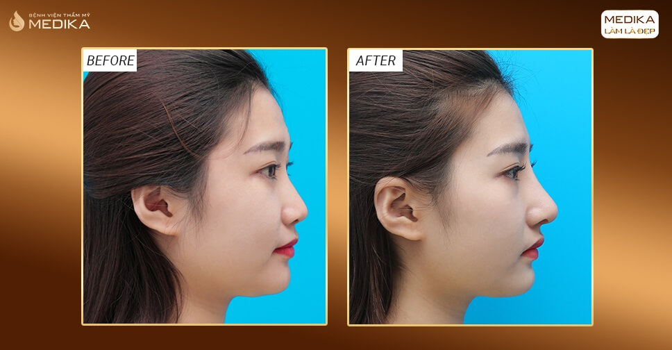 Phẫu thuật nâng mũi an toàn mang đến một chiếc mũi hoàn hảo - MEDIKA.vn
