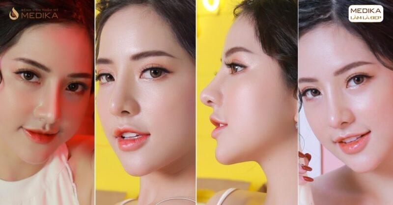 Phẫu thuật nâng mũi đẹp mang đến chiếc mũi hài hòa cho khách - Bệnh viện thẩm mỹ MEDIKA