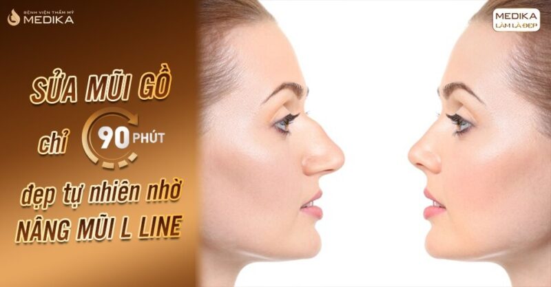 Sửa mũi gồ chỉ 90 phút đẹp tự nhiên nhờ nâng mũi L line - Bệnh viện thẩm mỹ MEDIKA