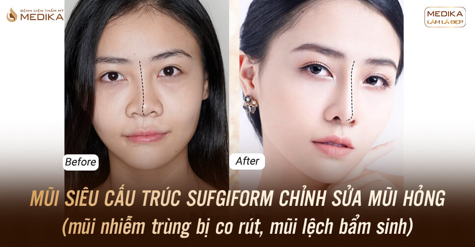 Nâng mũi siêu cấu trúc Surgiform chỉnh sửa mũi hỏng - MEDIKA.vn