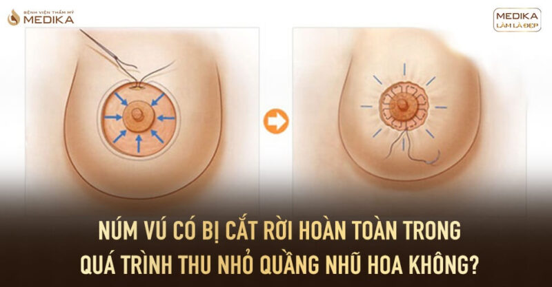 Thu nhỏ quầng nhũ hoa núm vú có bị cắt rời hoàn toàn không?