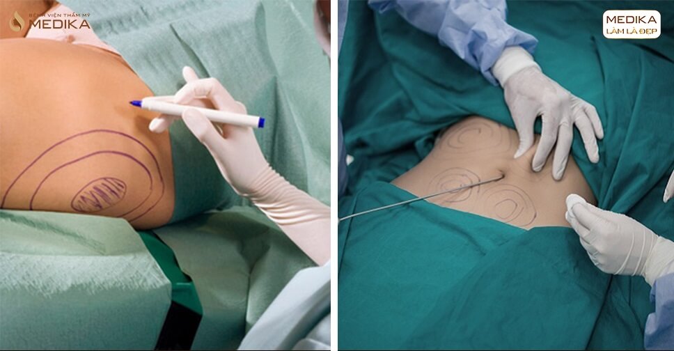 hut-mo-an-toan-tai-medika-giai-phap-loai-bo-mo-thua-chuan-y-khoa