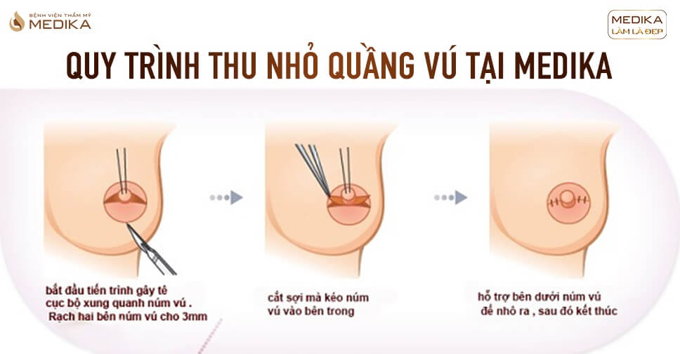 Thu nhỏ quầng nhũ hoa tiến hành gây tê hay gây mê?