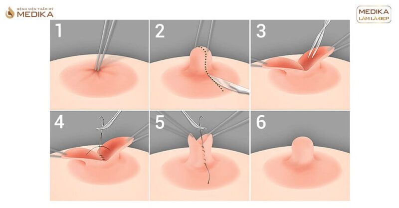 Kéo núm nhũ hoa tụt cải thiện khuyết điểm vòng 1