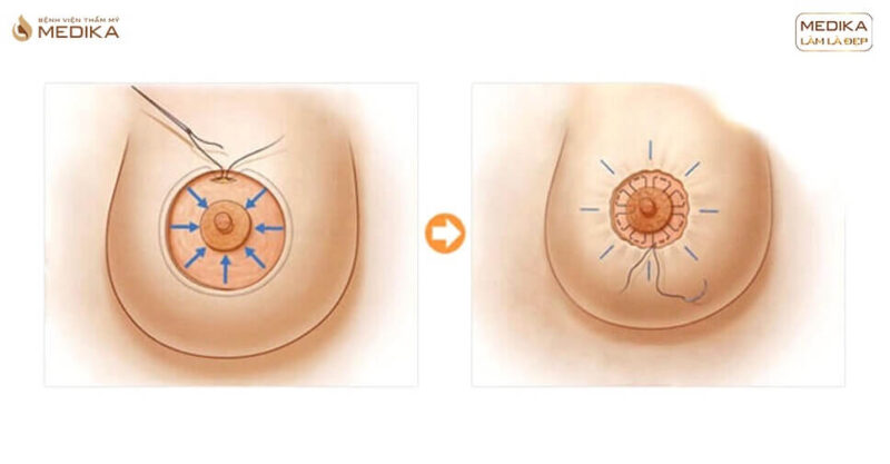 Thu nhỏ quầng nhũ hoa MEDIKA hạn chế biến chứng