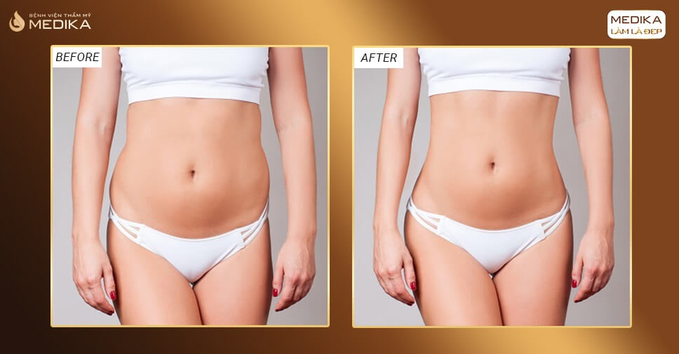 Quy trình hút mỡ tại Bệnh viện Thẩm mỹ MEDIKA