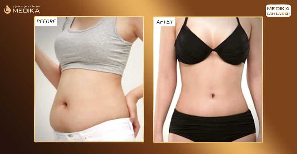 Chi phí hút mỡ bụng bao nhiêu là hợp lý? Xem ngay cách thực hiện