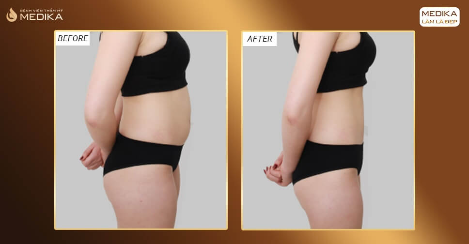 so-huu-voc-dang-hoan-hao-voi-cong-nghe-hut-mo-tai-medika