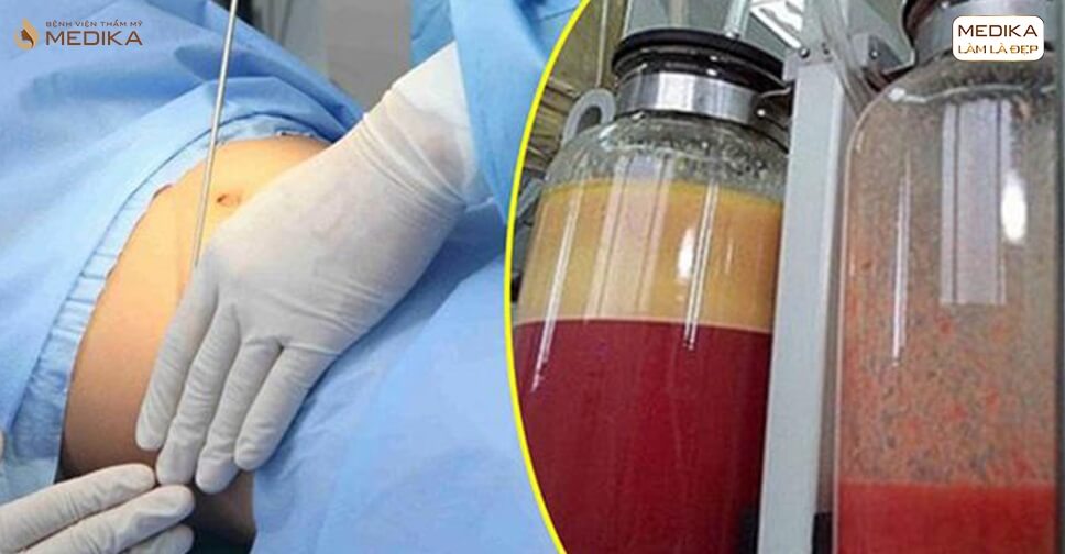 hut-mo-an-toan-tai-medika-giai-phap-loai-bo-mo-thua-chuan-y-khoa