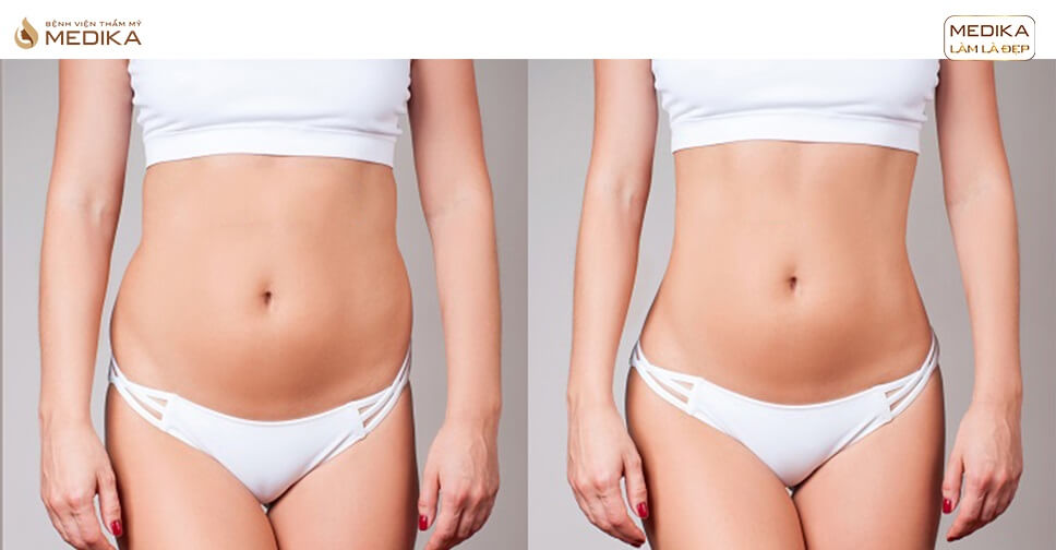 tao-hinh-bung-tai-bvtm-medika-co-hieu-qua-khong