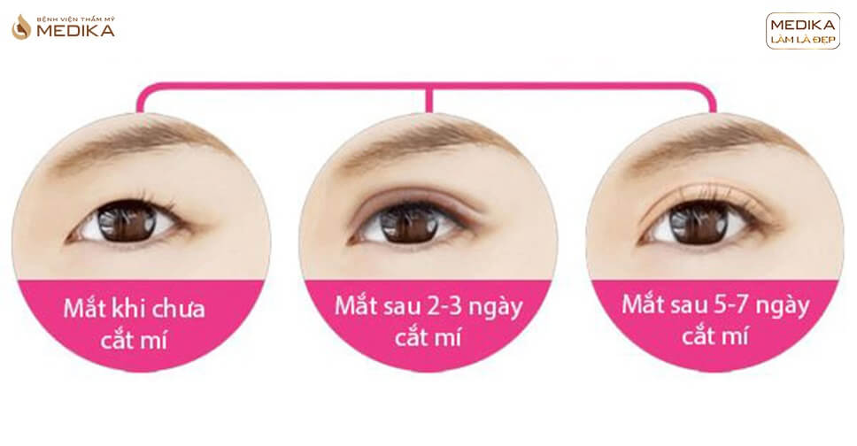 Cắt mí mắt review: Những điều cần biết trước khi cắt mí mắt