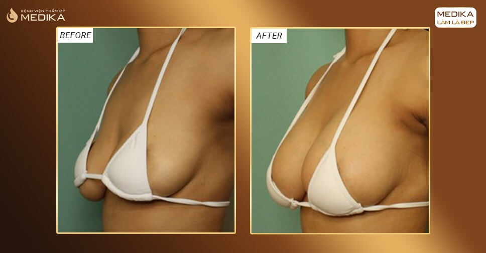 Hình ảnh trước sau nâng ngực chảy xệ tuổi U40 ở Medika