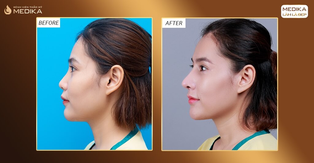 Thời gian vàng tháo nẹp và cắt chỉ để đạt hiệu quả nâng mũi đẹp bởi Bệnh viện thẩm mỹ MEDIKA