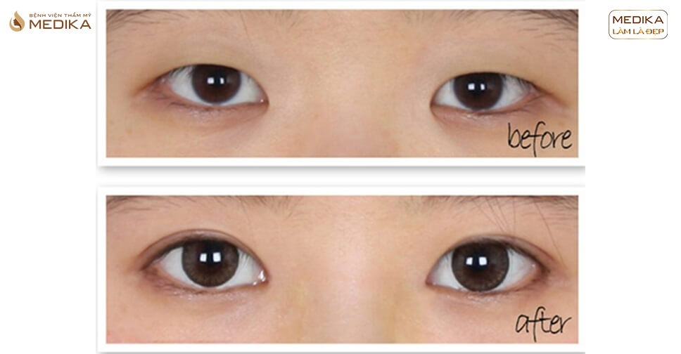 Bấm mí mắt sau bao lâu thì có thể sinh hoạt bình thường?