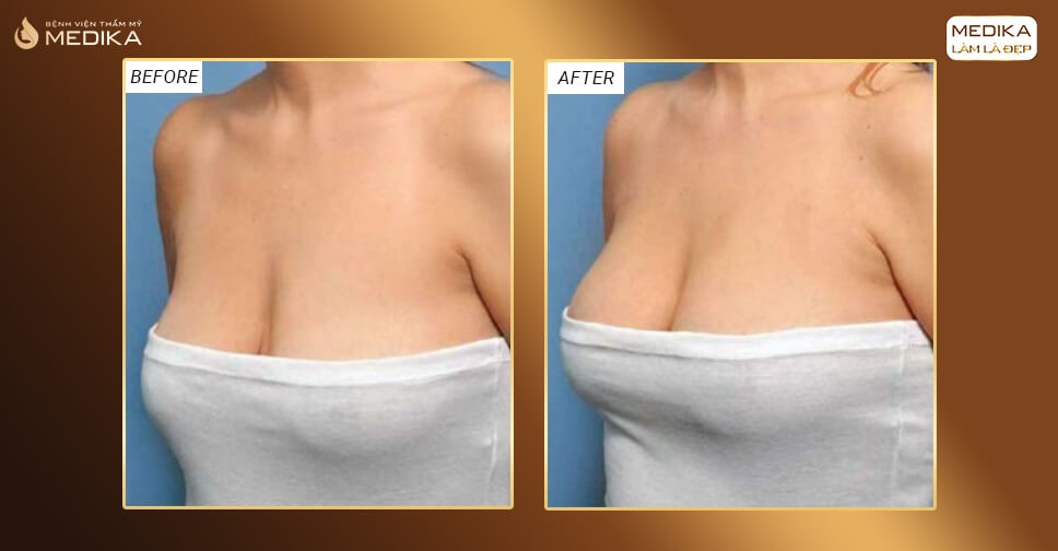 Hình ảnh trước sau nâng ngực chạy xệ ở Medika được chị em tin tưởng