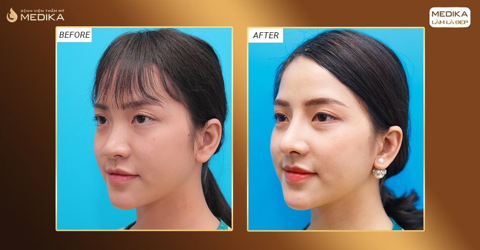 Hình ảnh trước và sau khi nâng mũi an toàn không bị sẹo lồi