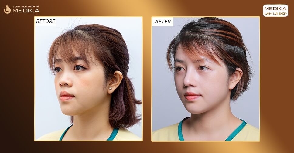 Hình ảnh trước và sau khi nâng mũi surgiform cho vẻ đẹp tự nhiên